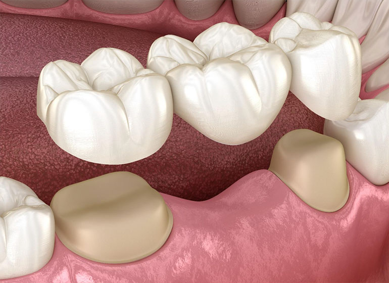 prótese dentária - protese fixa, em São Paulo. prótese dentária - protese fixa, em São Paulo.