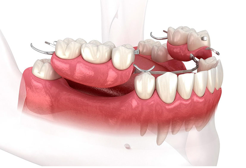 Próteses Parciais Removíveis, em São Paulo Próteses Parciais Removíveis, em São Paulo