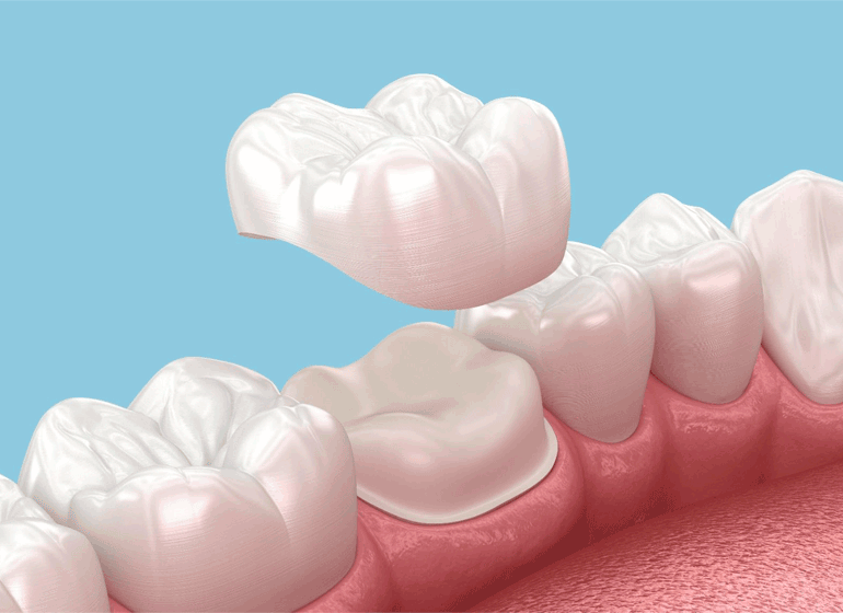 prótese dentária - coroa, em São Paulo. prótese dentária - coroa, em São Paulo.<br />