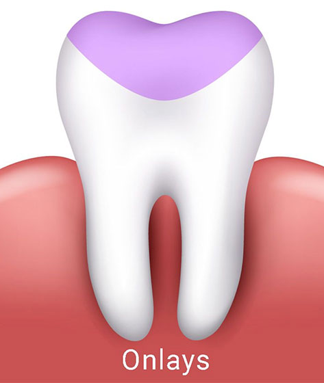 prótese dentária - onlays, em São Paulo. prótese dentária - onlays, em São Paulo.