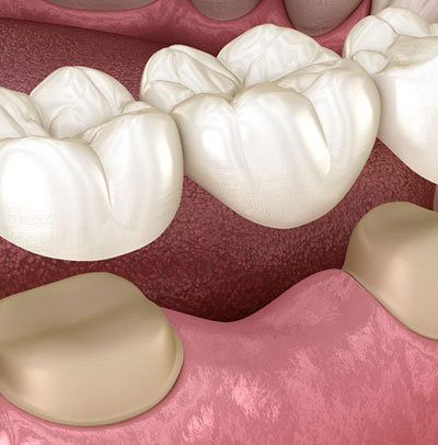 prótese dentária - protese fixa, em São Paulo.