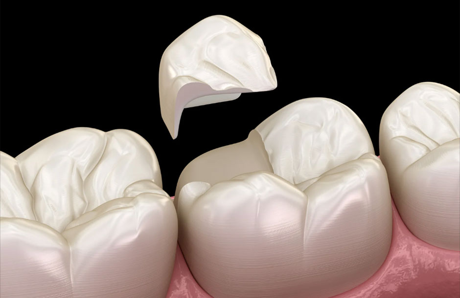 Restauração dental - Onlay Restauração dental - Onlay