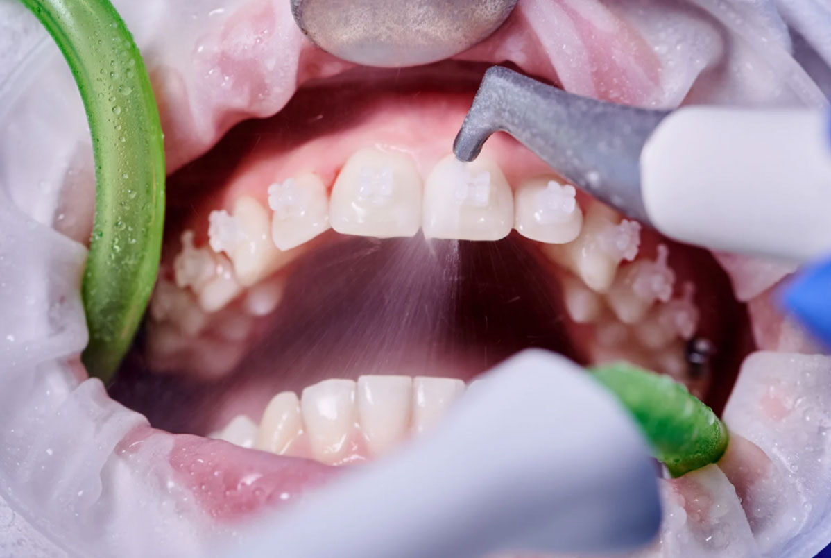 Benefícios da limpeza dental (profilaxia) Benefícios da limpeza dental (profilaxia)