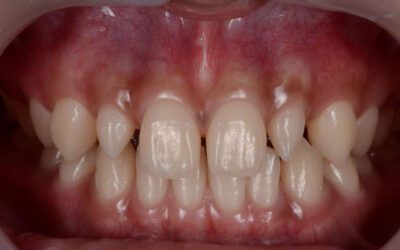 Dentes conóides: o que são, quais os impactos estéticos e como tratar