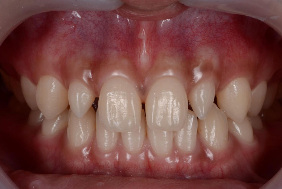 Dentes conóides: o que são, quais os impactos estéticos e como tratar Dentes conóides: o que são, quais os impactos estéticos e como tratar<br />