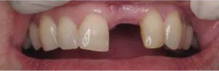 Espaço deixado pelo dente perdido Espaço deixado pelo dente perdido