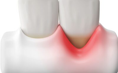 Importância da Limpeza Dental com AirFlow para Retração Gengival