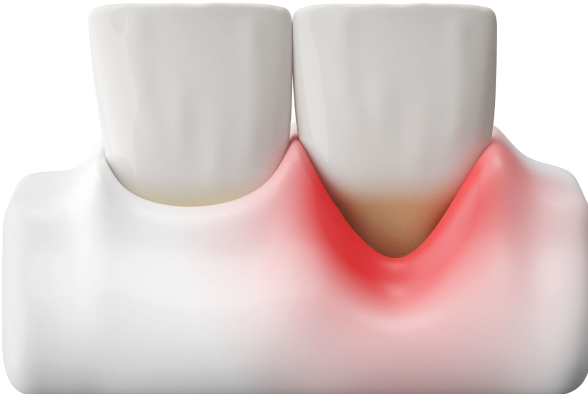 Importância da Limpeza Dental com AirFlow para Retração Gengival Importância da Limpeza Dental com AirFlow para Retração Gengival