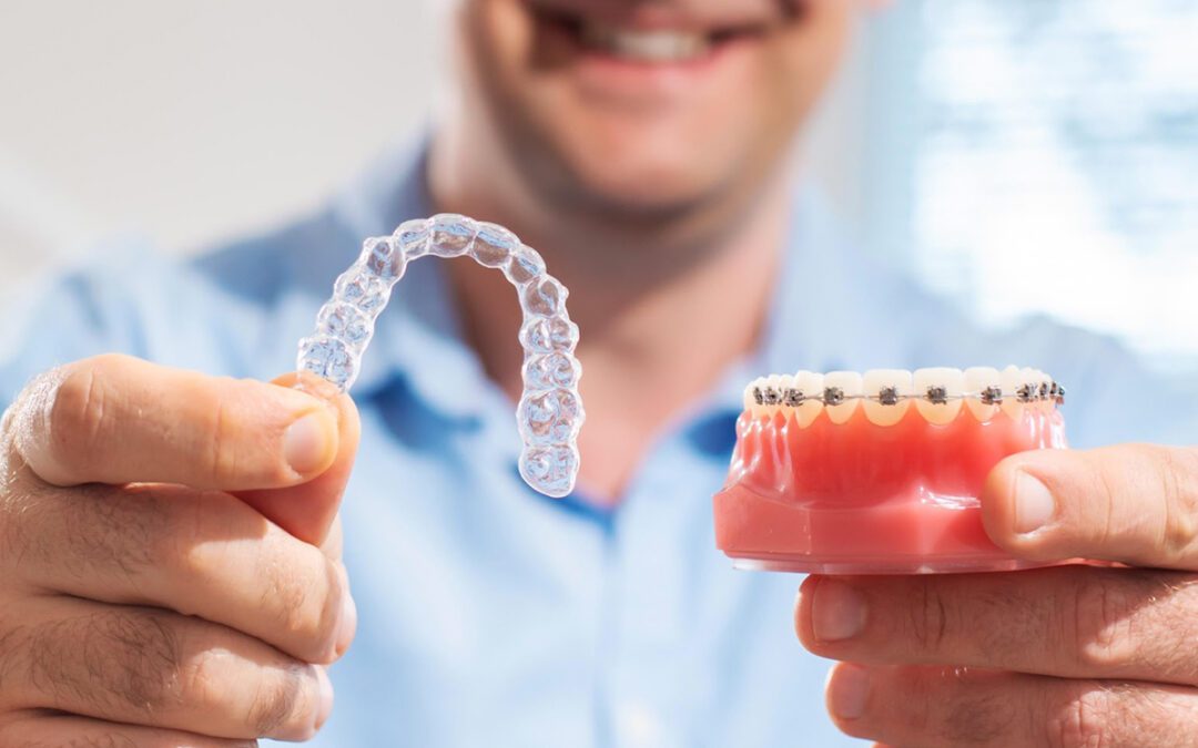 Invisalign é mais caro que o aparelho Fixo?