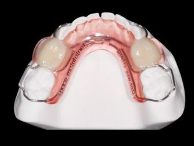 Mantenedor de espaço removível Mantenedor de espaço removível<br />