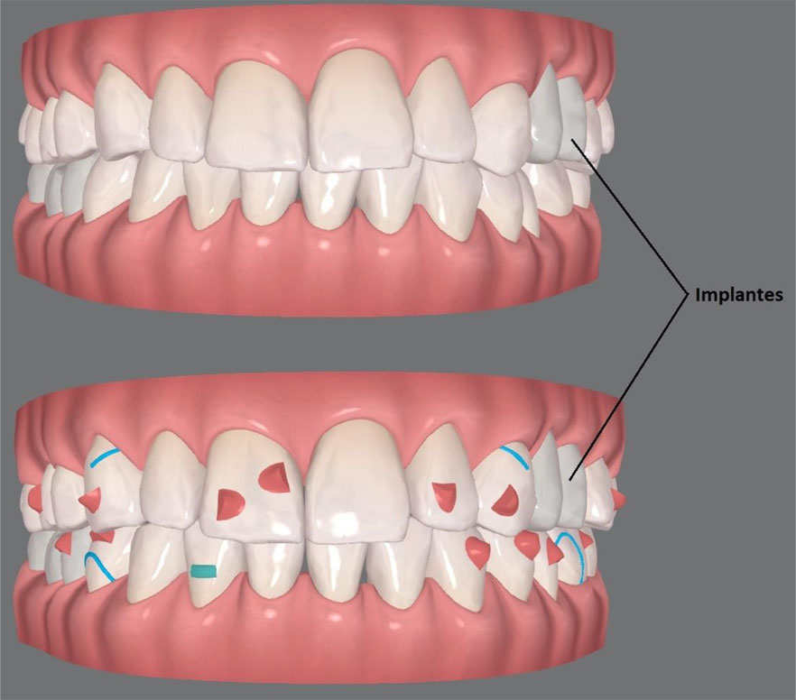 Planejamento ortodôntico com alinhadores Invisalign para um paciente que tem implante Planejamento ortodôntico com alinhadores Invisalign para um paciente que tem implante<br />