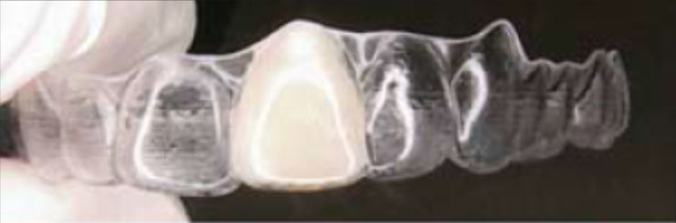 Pôntico instalado em um alinhador Invisalign Pôntico instalado em um alinhador Invisalign