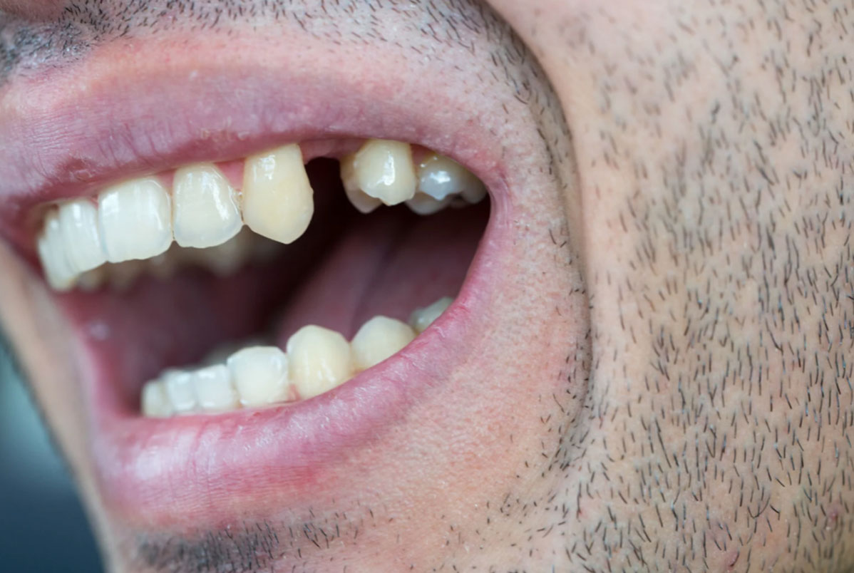 Quem tem dentes faltando pode usar Invisalign? Quem tem dentes faltando pode usar Invisalign?