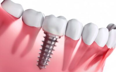 Quem tem implante pode usar o Invisalign?