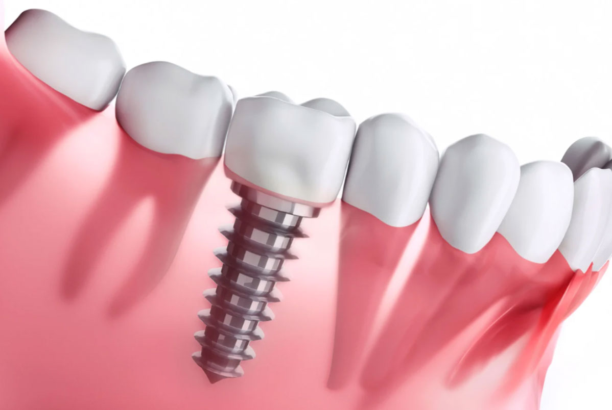 Quem tem implante pode usar o Invisalign? Quem tem implante pode usar o Invisalign?<br />