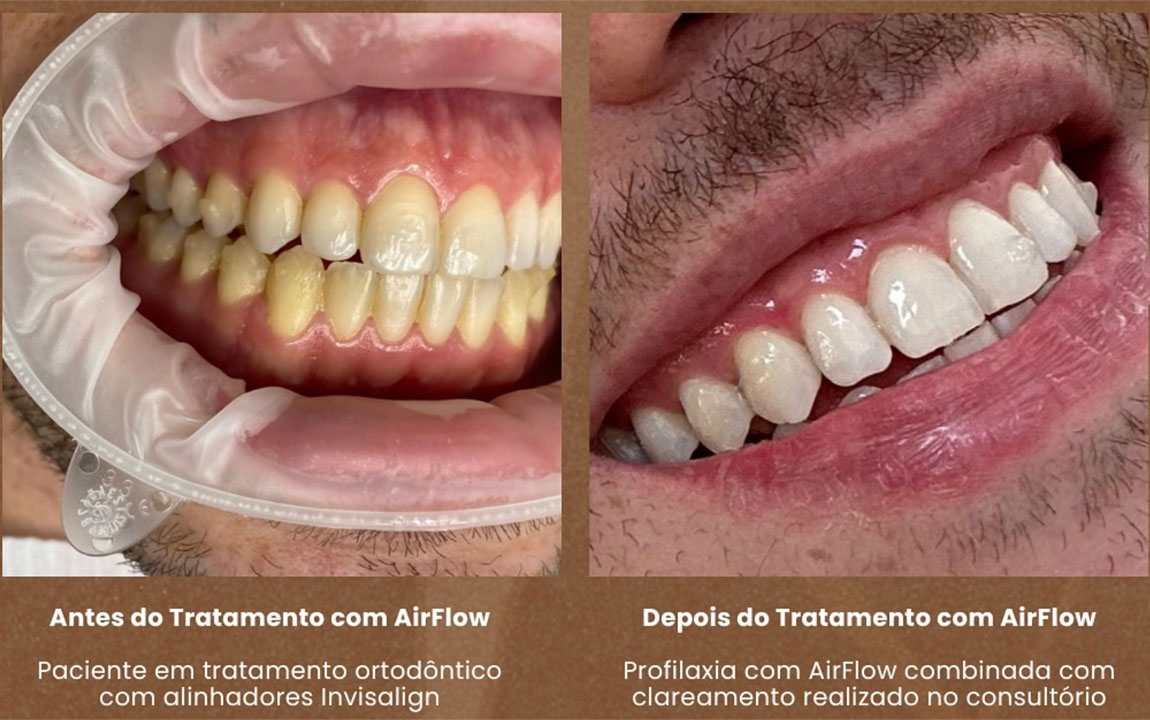 Antes e Depois com limpeza dental com Airflow, em São Paulo Antes e Depois com limpeza dental com Airflow, em São Paulo