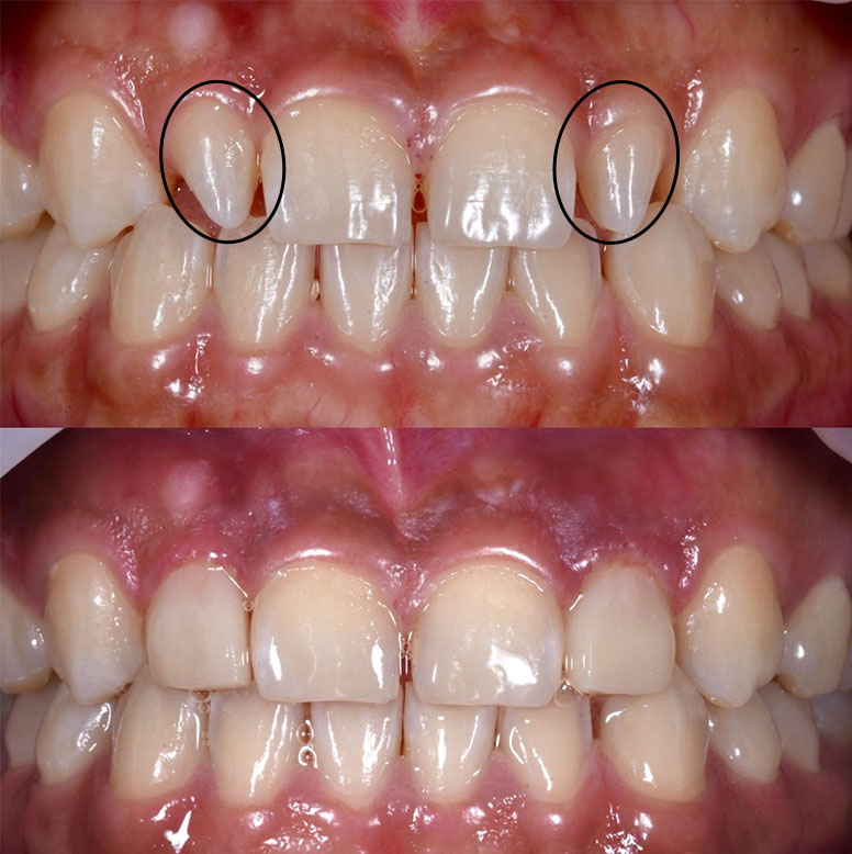 Dentes conóides Dentes conóides