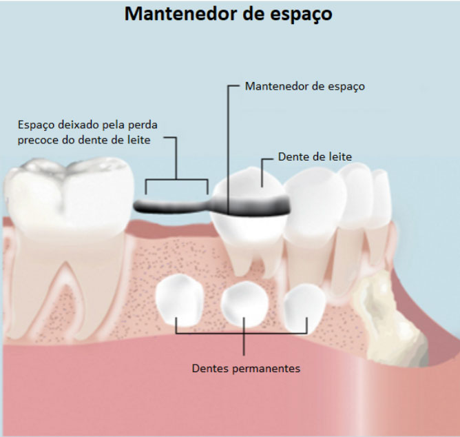 Mantenedor de Espaço Mantenedor de Espaço