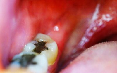 Devo trocar as minhas restaurações antigas de amálgama?