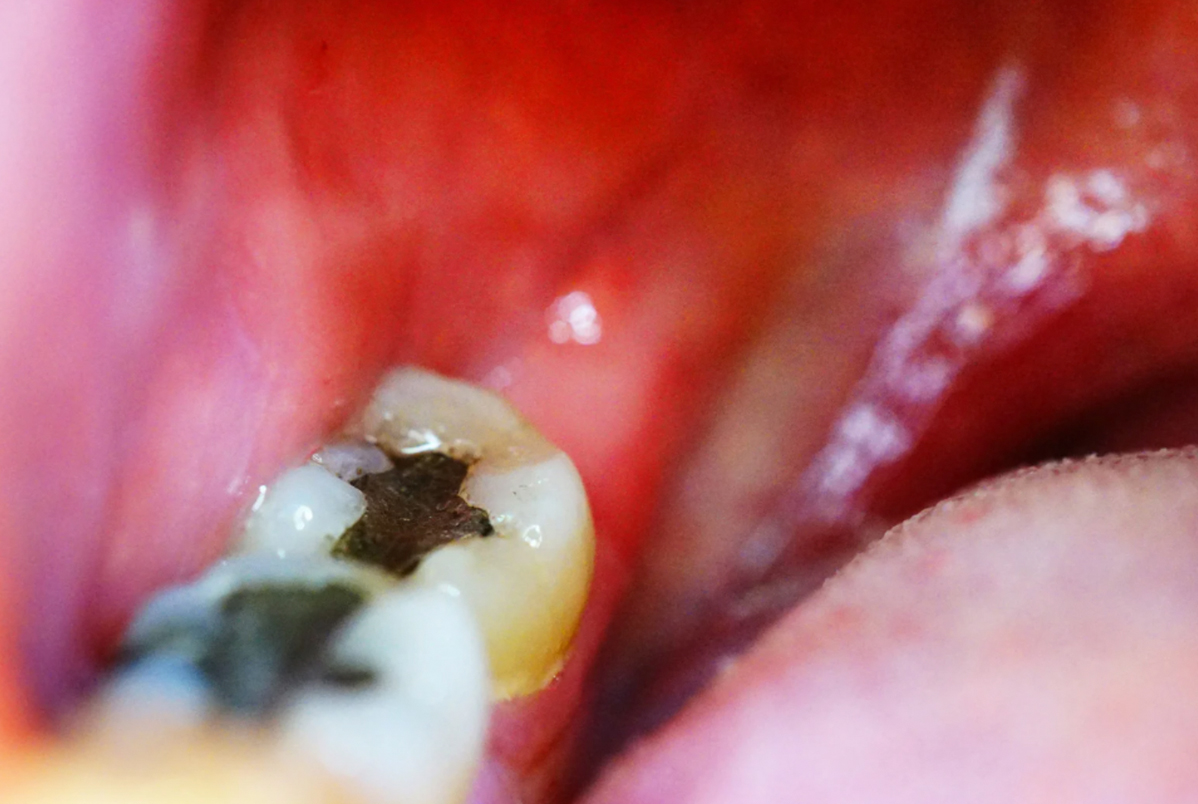 restauração metálica nos dentes restauração metálica nos dentes