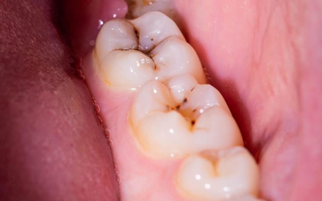 Cárie Dentária: sintomas, tratamentos e como prevenir