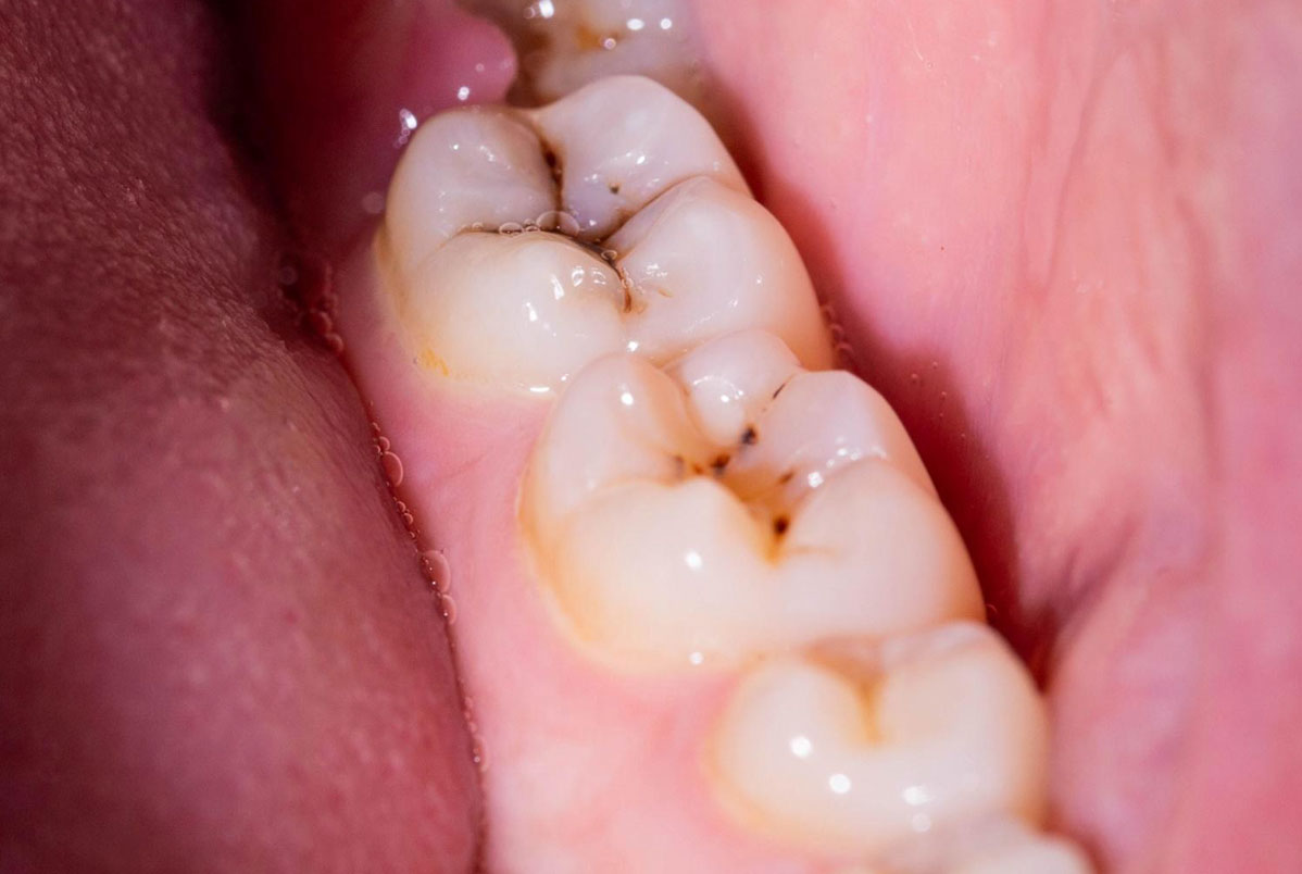 Cárie Dentária: sintomas, tratamentos e como prevenir