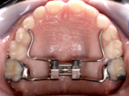 Disjuntor palatino Disjuntor palatino