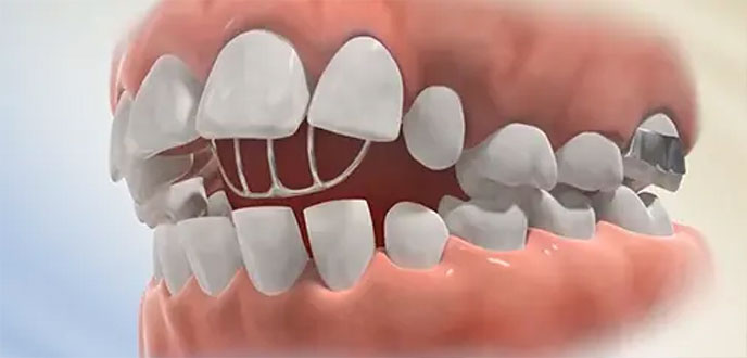 Grade palatina para inibir hábitos de sucção de dedo ou chupeta Grade palatina para inibir hábitos de sucção de dedo ou chupeta<br />