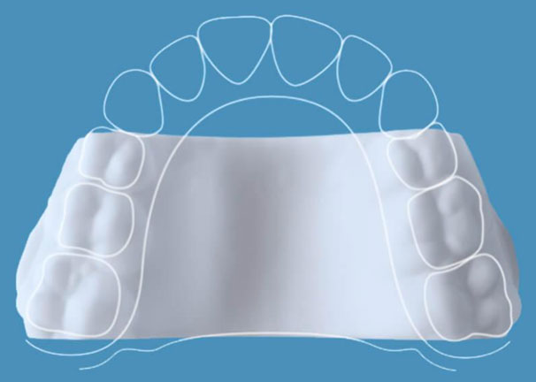 Invisalign Expander Invisalign Expander