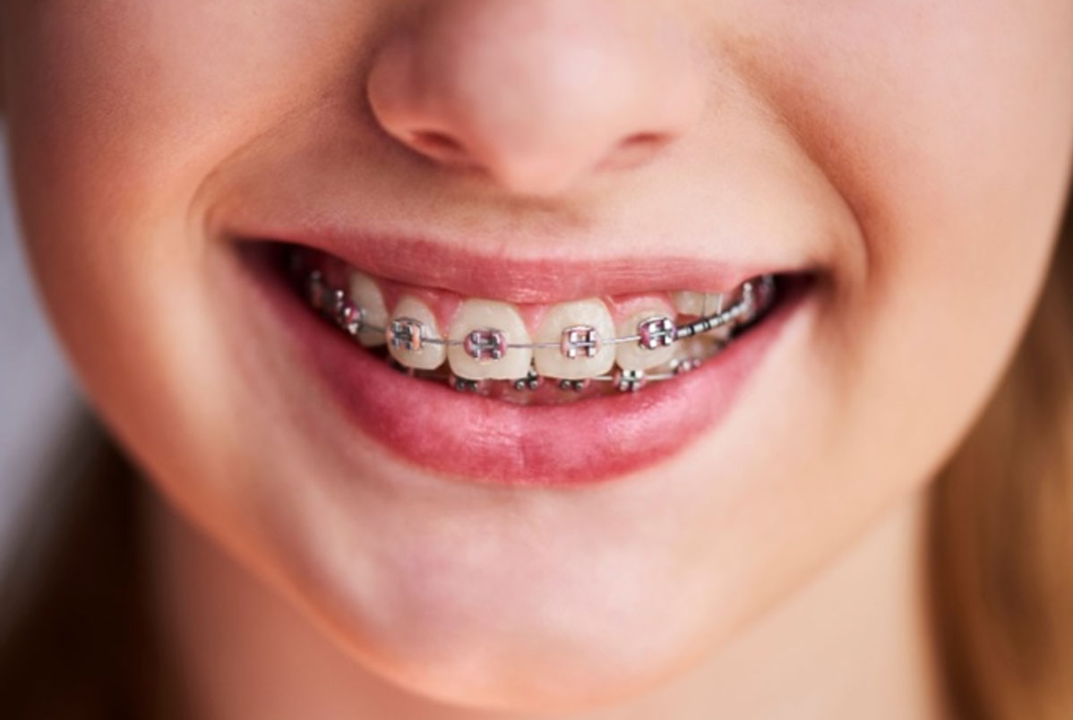 Recidiva: quando os dentes entortaram ou movimentaram depois de tirar o aparelho