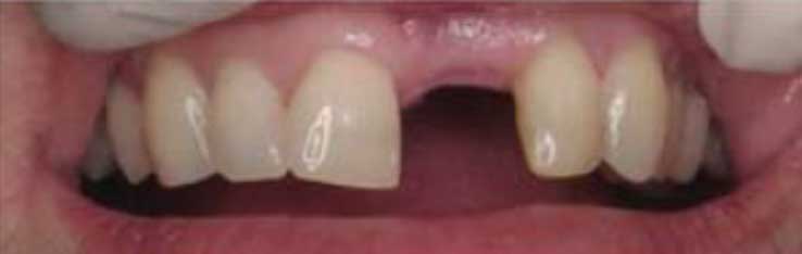 Espaço deixado pelo dente perdido Espaço deixado pelo dente perdido