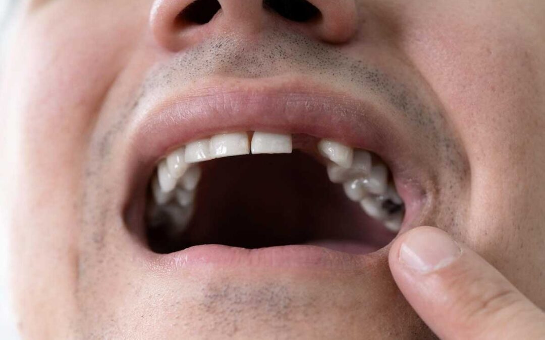 O que é um pôntico e como ele pode ser usado em tratamentos com Invisalign?