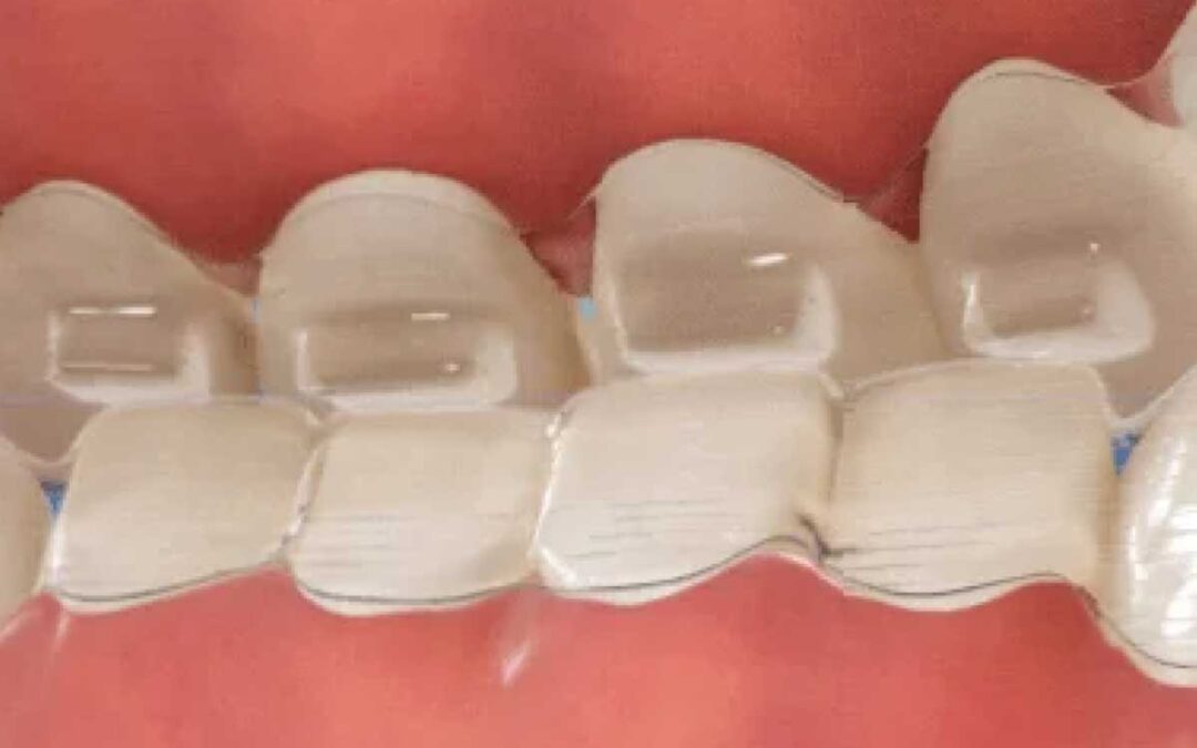 O que são bite ramps no tratamento Invisalign?