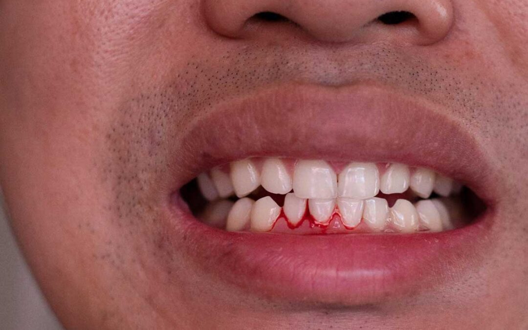 Sangramento na gengiva ao escovar: quando se preocupar?