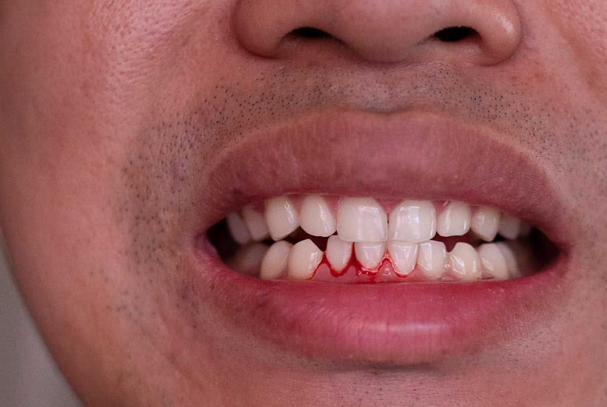 Sangramento na gengiva ao escovar: quando se preocupar? Sangramento na gengiva ao escovar: quando se preocupar?
