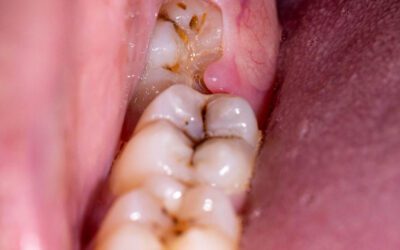 Todo pontinho preto no dente é cárie?