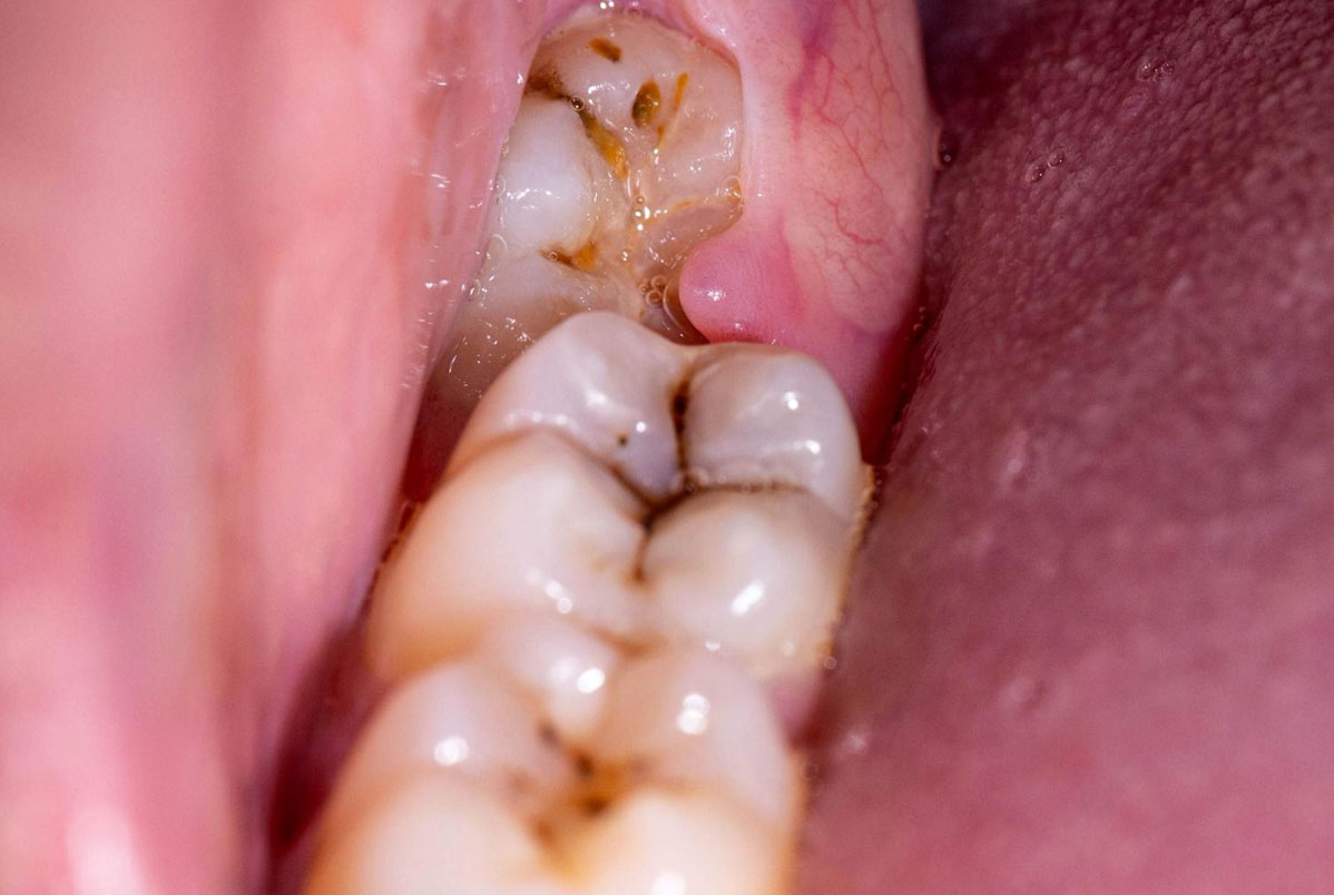 Todo pontinho preto no dente é cárie? Todo pontinho preto no dente é cárie?