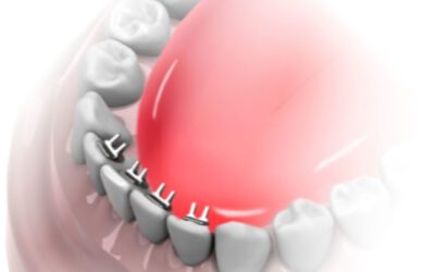 Esporões linguais na ortodontia com Invisalign: quando são indicados e como funcionam