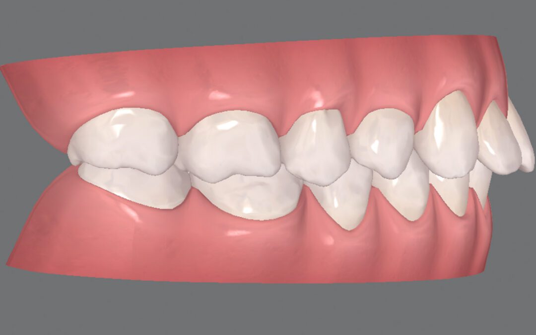 Tenho Classe II. Posso usar Invisalign?