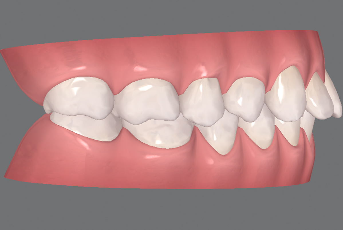 Tenho Classe II. Posso usar Invisalign? Tenho Classe II. Posso usar Invisalign?<br />