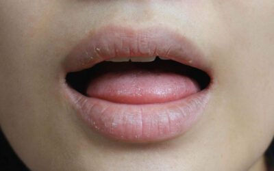 Boca seca (xerostomia): conheça os sintomas, prejuízos para a saúde bucal e possíveis tratamentos