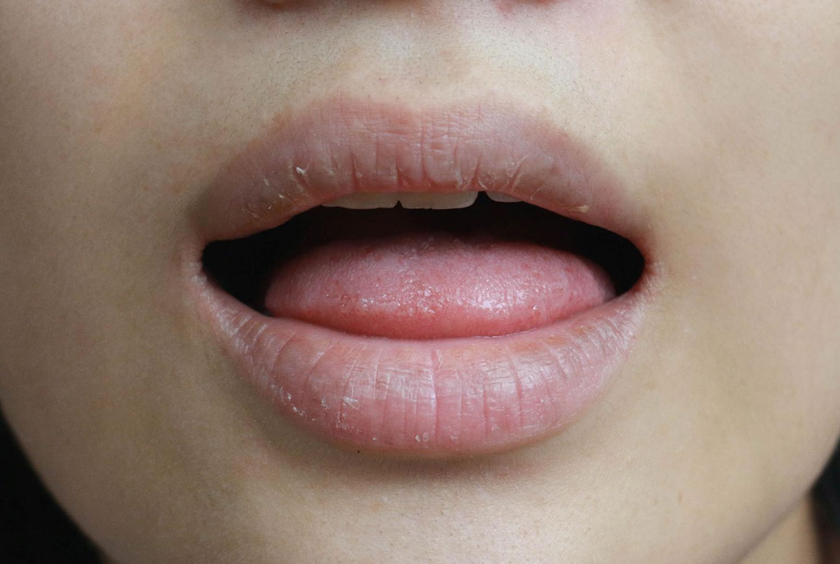 Boca seca (xerostomia) Boca seca (xerostomia)