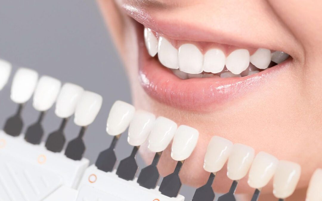 Clareamento dental em São Paulo
