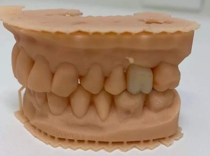 Coroa total confeccionada a partir do escaneamento 3D – Laboratório Precision Coroa total confeccionada a partir do escaneamento 3D – Laboratório Precision