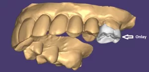 Exemplo de um desenho do projeto de uma restauração onlay Exemplo de um desenho do projeto de uma restauração onlay