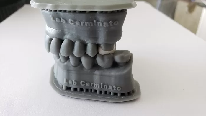 estauração onlay confeccionada a partir do escaneamento 3D – Laboratório Carminato estauração onlay confeccionada a partir do escaneamento 3D – Laboratório Carminato