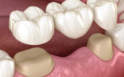 Como a prótese dentária pode aumentar a autoestima e a confiança