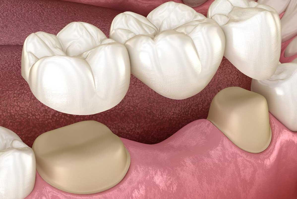 Como a prótese dentária pode aumentar a autoestima e a confiança Como a prótese dentária pode aumentar a autoestima e a confiança