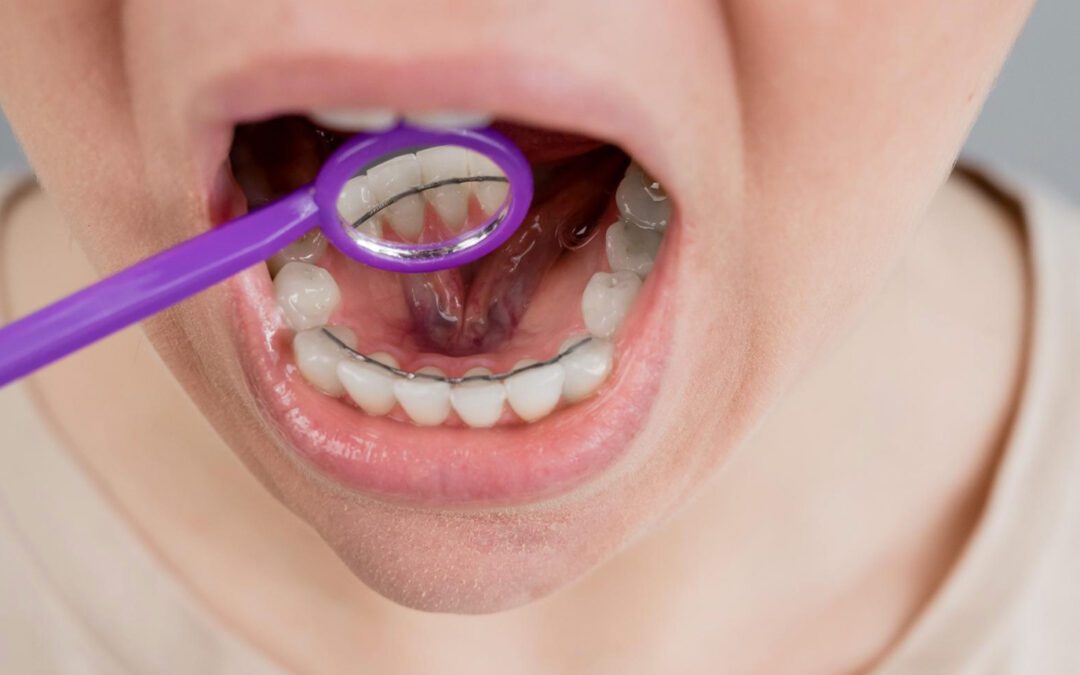 Cuidados com a higienização bucal para quem usa contenção fixa