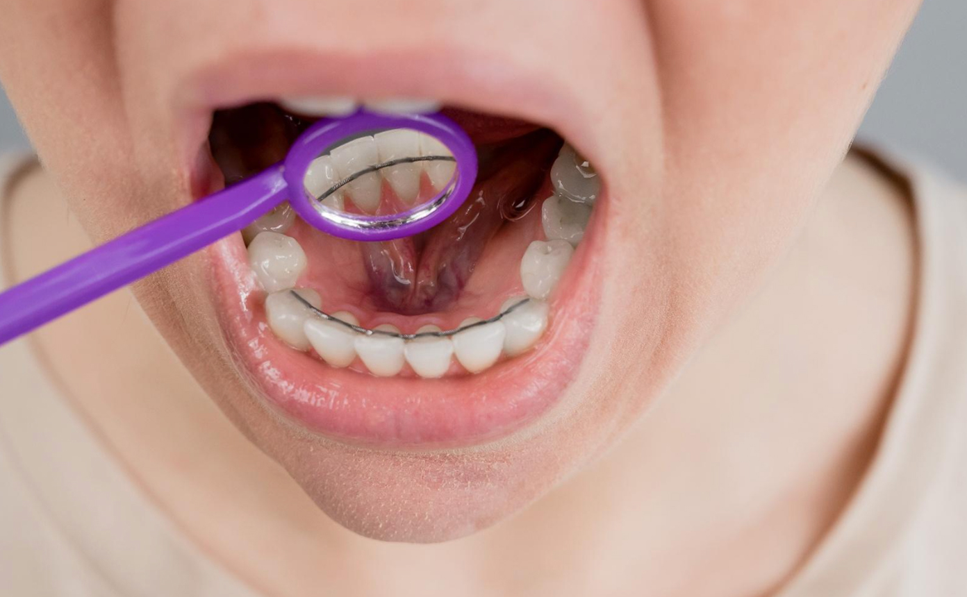 Cuidados com a higienização bucal para quem usa contenção fixa<br />
